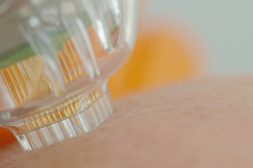 can do microneedling after Botox