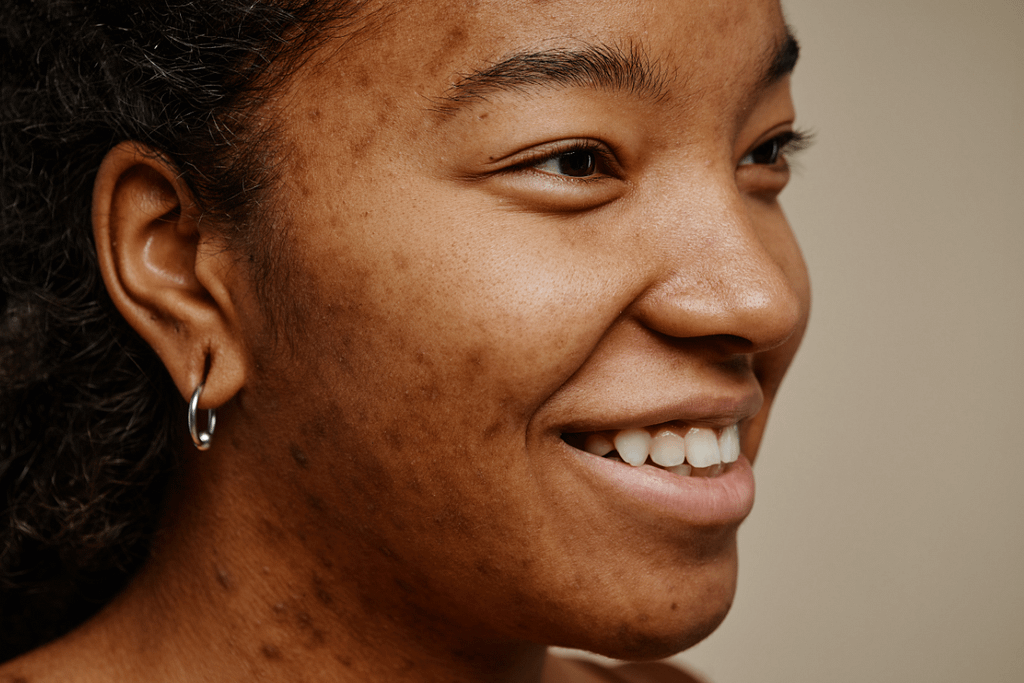 Can Microneedling Cause Acne