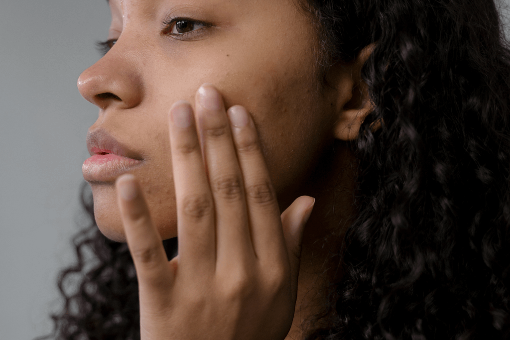 Can Microneedling Cause Acne